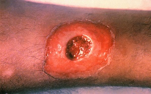 Diphtheria skin lesion (from the Centers for Disease Control)